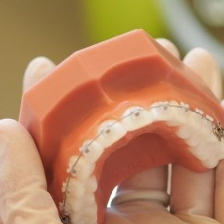 Festsitzende Zahnspangen – Brackets