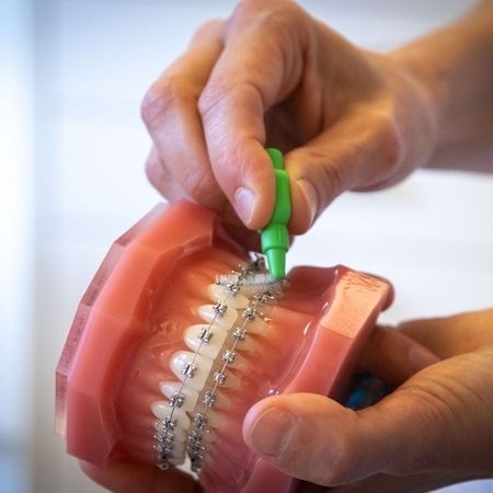 Festsitzende Zahnspangen – Brackets