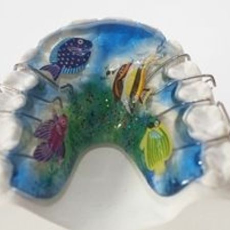 Abnehmbare Zahnspangen