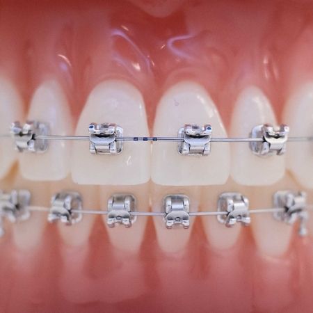 Nahaufnahme einer Zahnspange