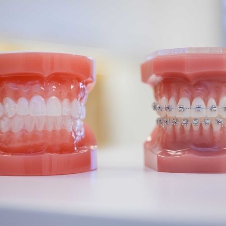 Nahaufnahme einer Zahnspange